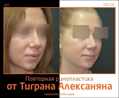 Тигран Алексанян. Фото до и после ринопластики