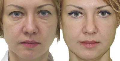Пластика верхних и нижних век у женщины: фото до и после — через 6 месяцев  | Пластический хирург Орландо Салас