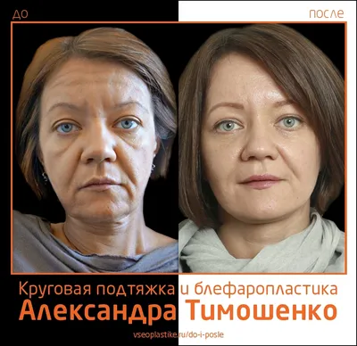 Александр Тимошенко. До и после круговой подтяжки лица и пластики век