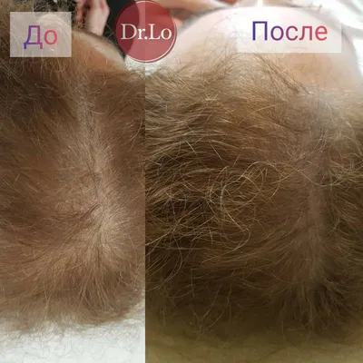 Лечение Волос Уникальным Лазером | Трихолог