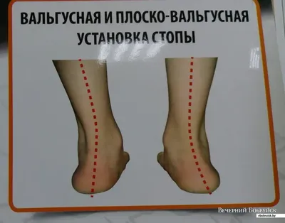Как появляются Х-образные и О-образные ноги. Рассказ детского хирурга и его  рекомендации родителям | bobruisk.ru