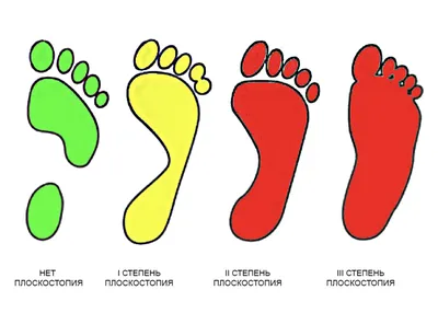 Виды плоскостопия - Детская обувь Twinboots