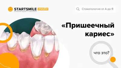 Пришеечный кариес - что это такое и чем опасен? смотреть онлайн видео от  Startsmile – экспертный журнал о стоматологии в хорошем качестве.