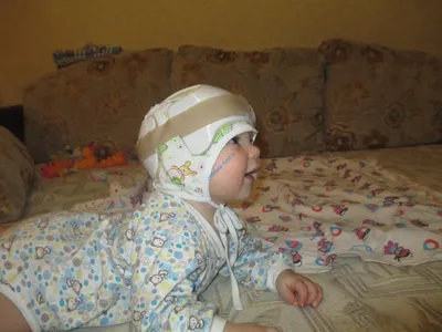 Мы очень довольны результатом лечения Ванечки шлемами - Лицо Ребенка -  благотворительный фонд
