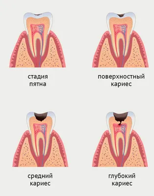 Лечение кариеса в Омске. Цена за лечение кариеса в 2022 году | Стоматология  АлексДент