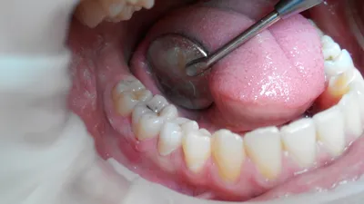 Лечение кариеса - цена в 32Dent :: Лечение глубокого и поверхностного  кариеса зубов