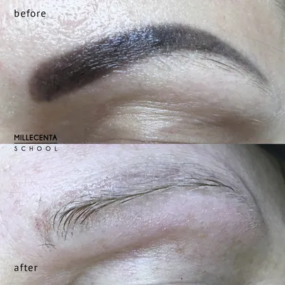 Фото до-после удаления перманентного макияжа - Перманентный макияж