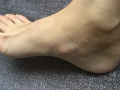 Шишки на ноге - Вопрос ортопеду-травматологу - 03 Онлайн