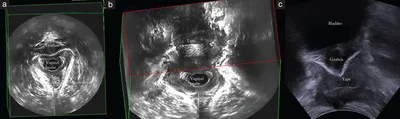 Связь между результатами 3D-эндовагинального и 2D-перинеального УЗИ  тазового дна и симптомами у женщин с осложнениями среднего уретрального  слинга | Блог RH