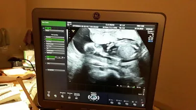 Видео УЗИ. 20 недель беременности. Пол ребенка. | Мама на всю голову | Дзен