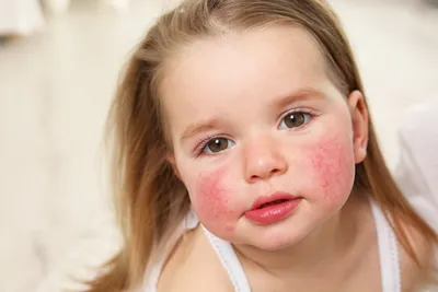 Туапсе | Аллергия — неизвестное об этой болезни - БезФормата