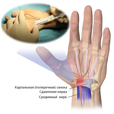 Боль в кистях рук — диагностика, лечение: причины боли в руках и венах