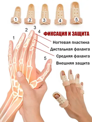 Как лечить узелки Бушара и Гебердена — наросты на суставах пальцев рук —  Homviora