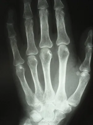 Медики: опухшие пальцы могут быть показателями болезни