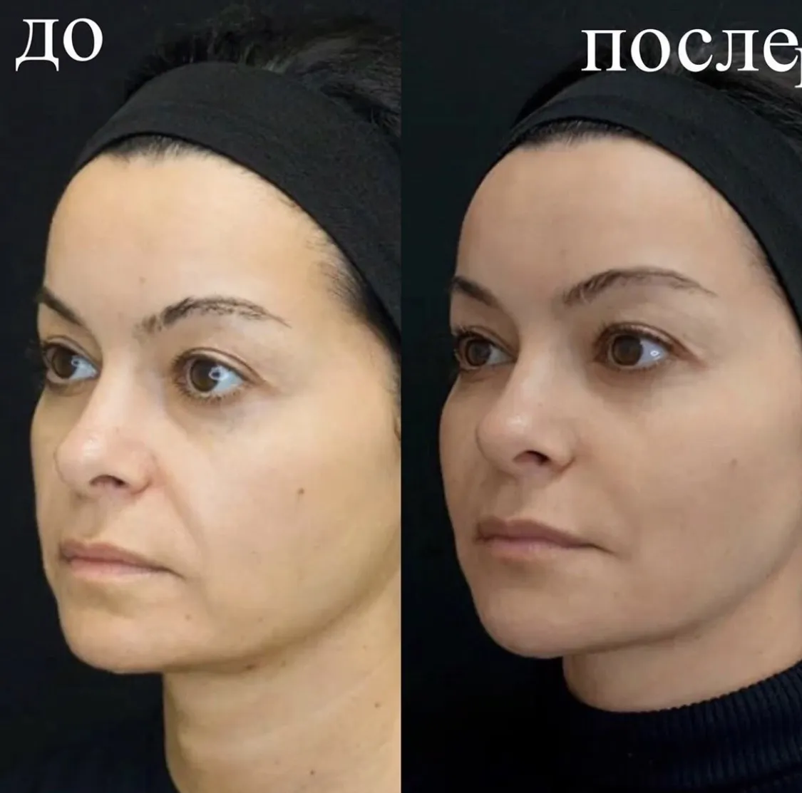 Белотеро филлер для лица до и после фото