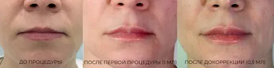 Увеличение губ в Москве. Безоперационное увеличение, косметология.