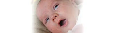 Новорождённый «зацвёл», или что делать с акне младенцев