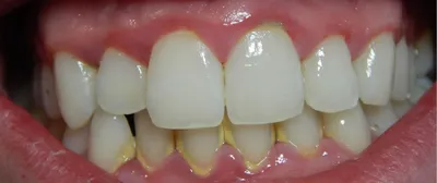 Белый зубной камень фото
