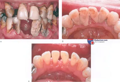 Зубной камень на зубах и имплантатах
