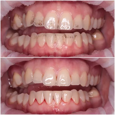 1 основная и 7 косвенных причин коричневого (темного) налета на зубах,  лечение