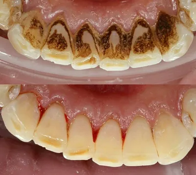 Зубной налет: причины образования и как от него избавиться? | DentaQ_ru |  Дзен