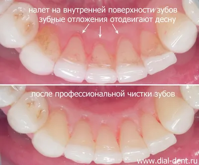 Профессиональная чистка зубов при тотальном протезировании керамикой