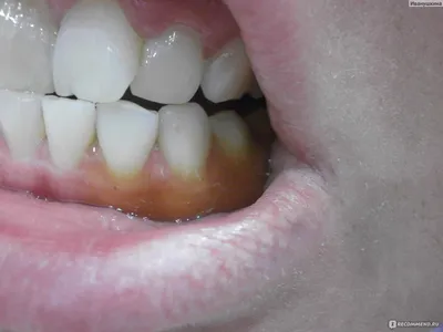 Ультразвуковая чистка зубов - «☆~ Ультразвуковая чистка зубов БЕСПЛАТНО, по  полису ОМС. Как проходит процедура и мои ощущения. ~☆ » | отзывы