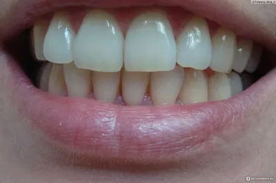 Профессиональная чистка зубов - «Профессиональная чистка зубов. Удаление зубного  камня и налета ультразвуком. Как проходит чистка зубов у стоматолога.  Результат проф. гигиены до и после. Рекомендации после чистки зубов.» |  отзывы