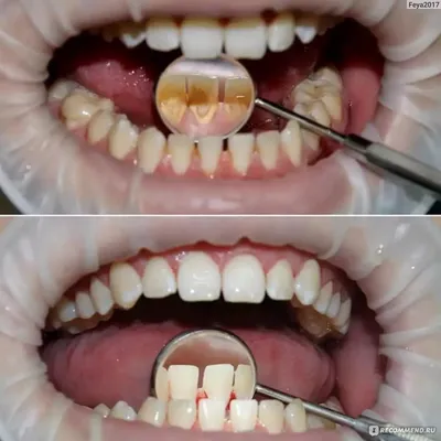 Профессиональная чистка зубов - «Профессиональная чистка зубов. Показания,  противопоказания, этапы. Мой личный опыт. Фото до и после профессиональной  чистки зубов.» | отзывы
