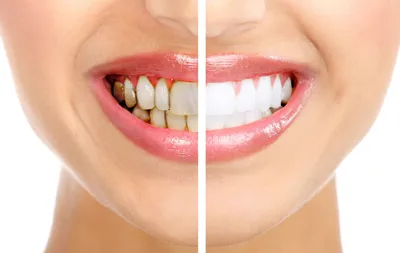 Как удалить зубной камень, и почему он появляется?