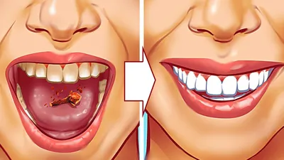 10 Натуральных Способов Устранить Зубной Камень - YouTube