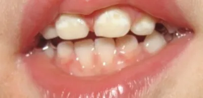 Белые пятна на молочных зубах › Деникон стоматологические материалы и  одноразовые расходники