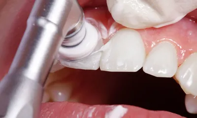 Удаление зубного камня в Уфе