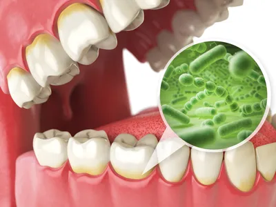Зубной налёт | Хорошая Стоматология