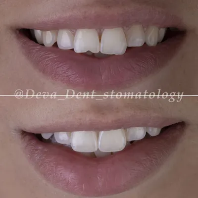 Фото художественных реставраций зубов | Фотогалерея Deva-Dent