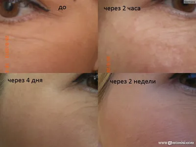 Инъекции гиалуроновой кислоты IAL-System. Биоревитализация кожи. -  «Непонятный результат. Фото до и после.» | отзывы