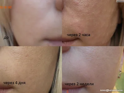 Инъекции гиалуроновой кислоты IAL-System. Биоревитализация кожи. -  «Непонятный результат. Фото до и после.» | отзывы