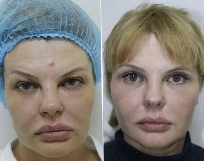 Круговая блефаропластика: цены в Москве, фото до и после операции | Сделать  круговую пластику век