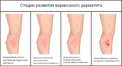 Лечение варикозного дерматита в Москве. Флебологический медицинский центр