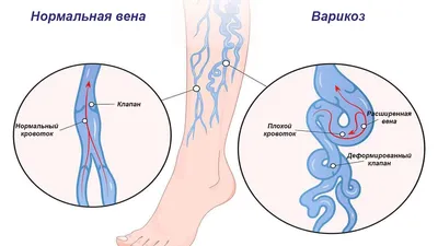 Как укрепить вены и сосуды на ногах при варикозе | «Институт Вен»