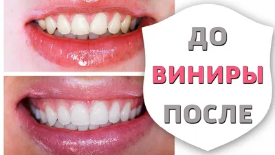 Виниры. Все этапы установки и изготовления | Зубы до и после установки  виниров | Дентал ТВ 12+ - YouTube