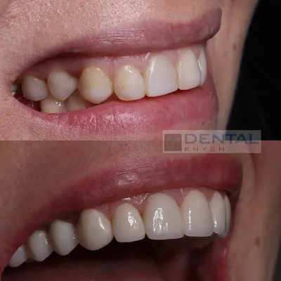 https://dentalknysh.com.ua/ru/viniry-do-posle-foto-otchety/