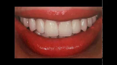 Определение цвета зубов - YouTube