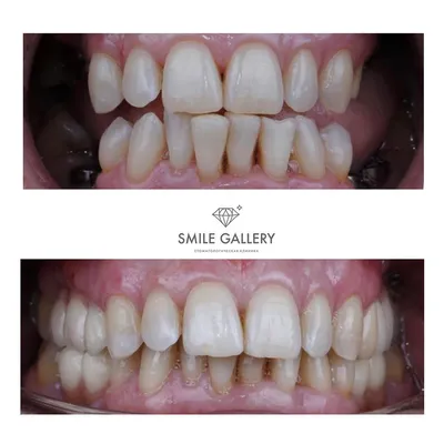 Стоматологическая ортопедия зубов в клинике Smile Gallery (г. Новосибирск)