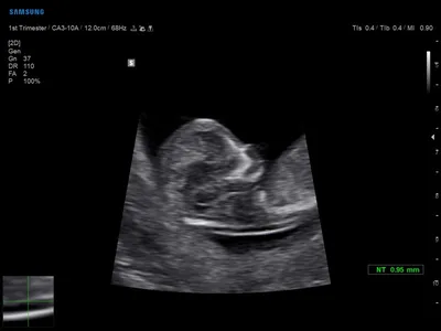 УЗИ в гинекологии и при беременности - HD live в пренатальной диагностике