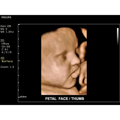 Лицо плода ребенка 20 недель старая, непосредственно на экране во время узи  Стоковое Фото - изображение насчитывающей антропологического, сторона:  171482276
