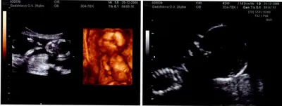 4D УЗИ во время беременности - «4 Д при беременности. Когда лучше делать 4  Д УЗИ? Похож ли ребёнок на фото УЗИ?» | отзывы