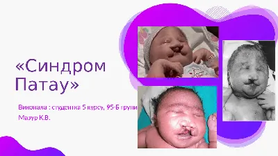 Синдром Патау 2022 (рус) | Презентации генетики | Docsity