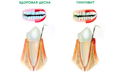 Воспаление (увеличение) лимфоузлов на шее - причины, симптомы, диагностика