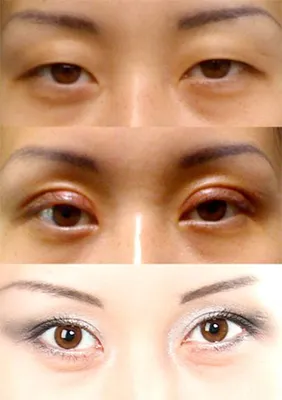 Азиатский разрез глаз – причины косметического дефекта, способы изменения  разреза